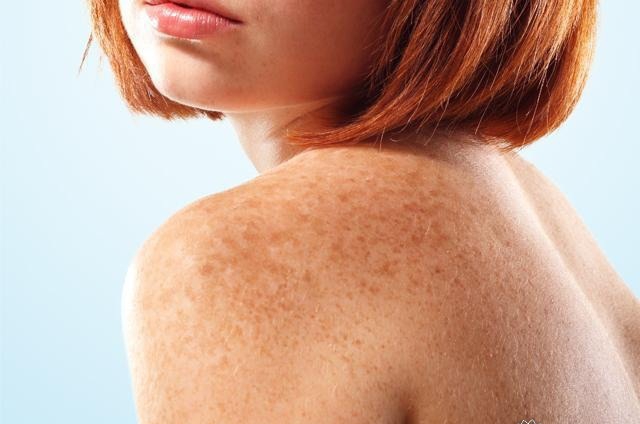 Пигментные пятна на плечах: причиной может быть загар