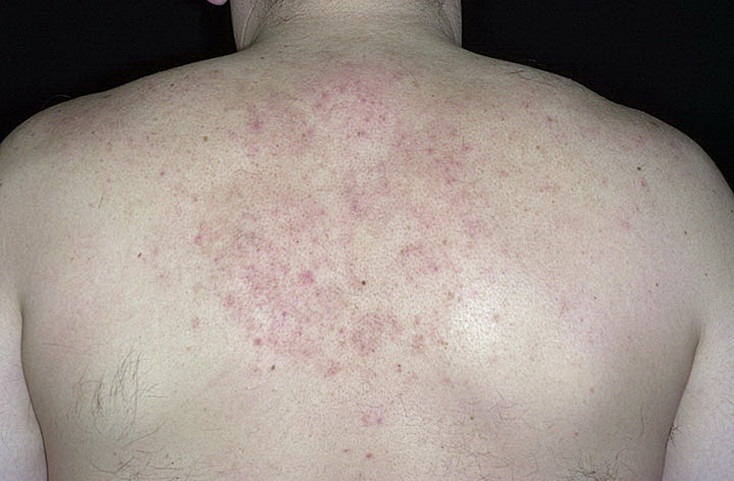 Себорейный дерматит на спине