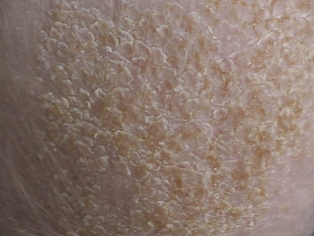 Так выглядит кожа, пораженная себорейным дерматитом