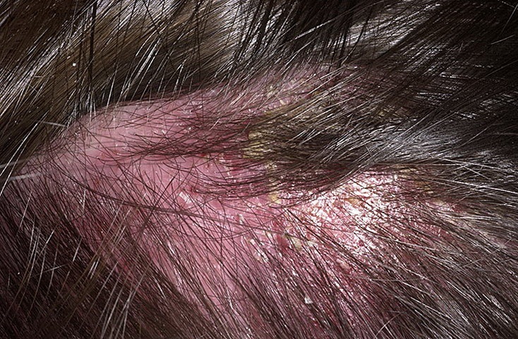 Себорейный дерматит кожи головы
