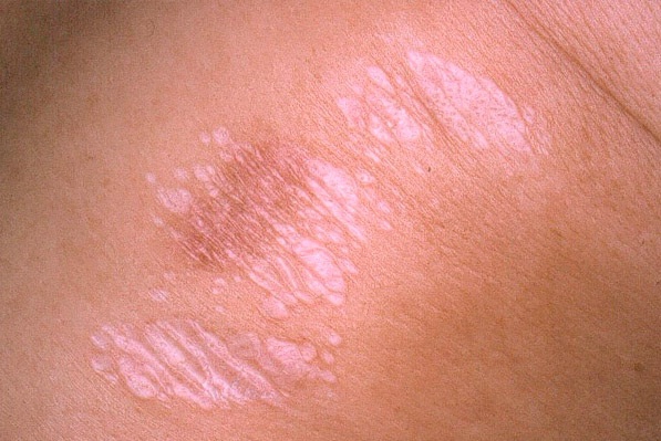 Изменения кожи, вызываемые склероатрофическим лишаем