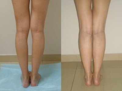 Вальгусная деформация голени фото до и после хирургического лечения