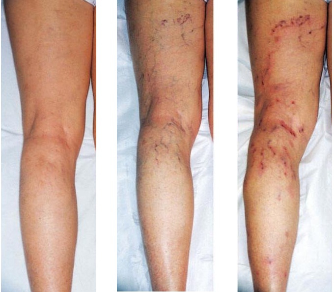 Этапы развития варикозного дерматита: от сосудистых звездочек до язв на коже