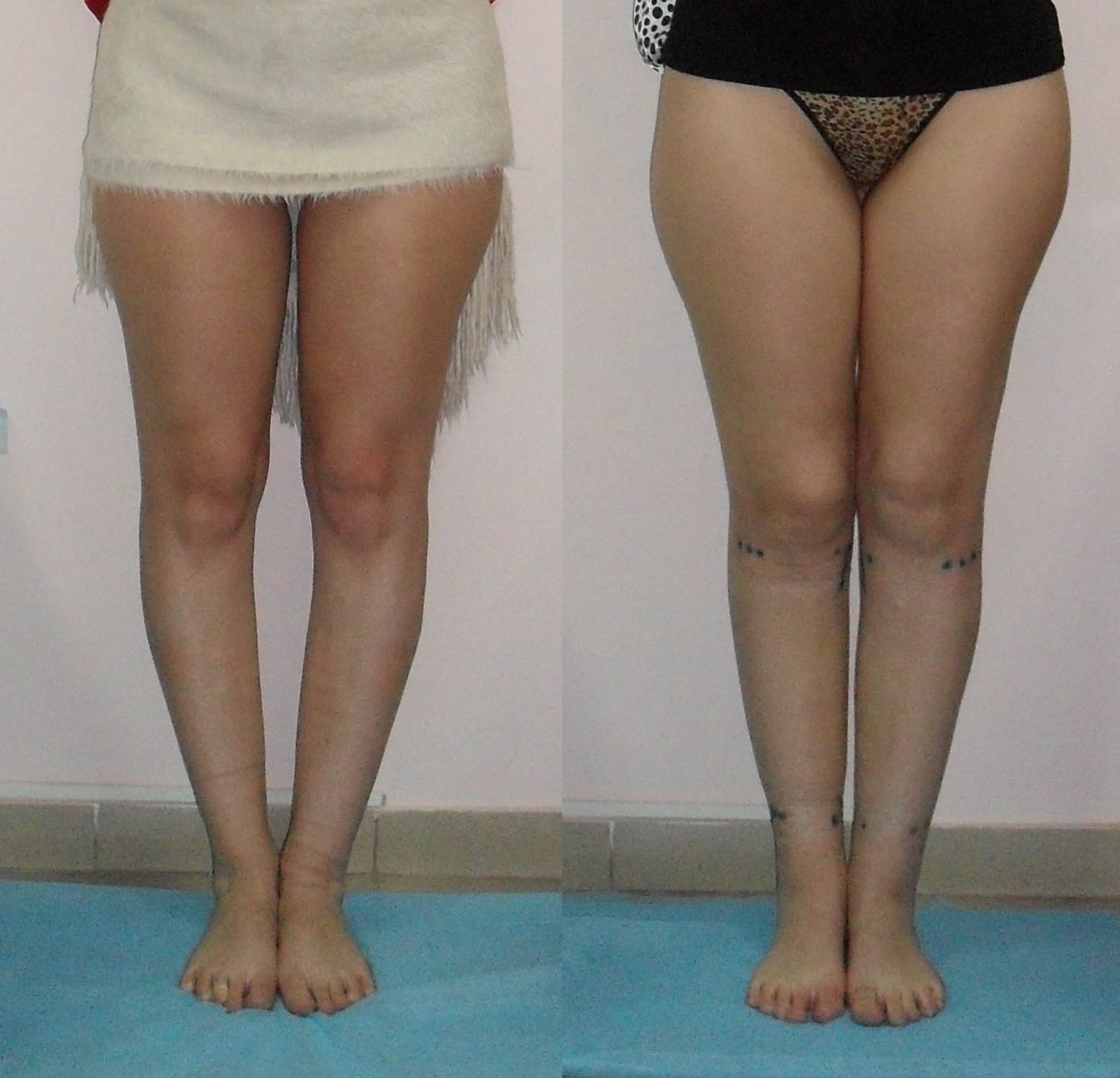 Фото до и после хирургического лечения варусного искривления голеней