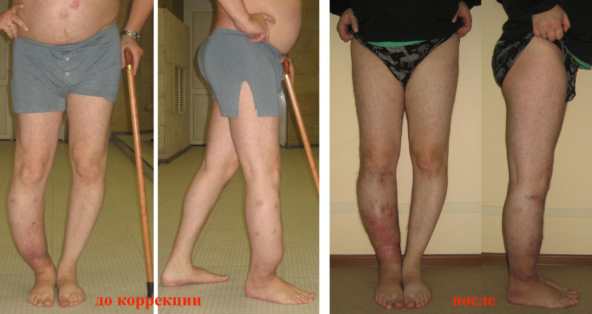 Пациенту сделана вальгизирующая остеотомия. Фото до и после коррекции искривления голеней