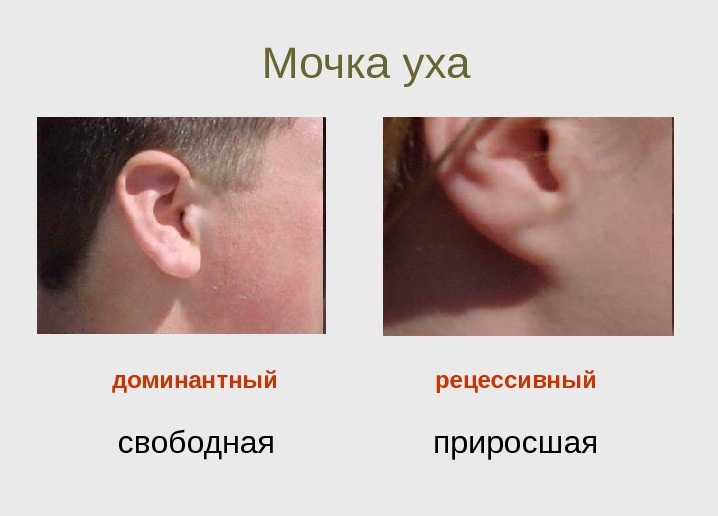 Приросшие мочки ушей – это рецессивный (слабый, подавленный) признак, характеризующийся недостатком жировой ткани в нижней части наружного уха