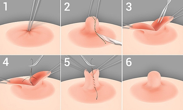 Как исправляют хирургическим способом втянутый сосок; фото с операции и этапы проведения
