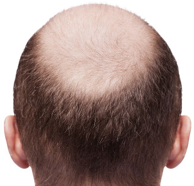 Выпадение волос (андрогенетическая алопеция)