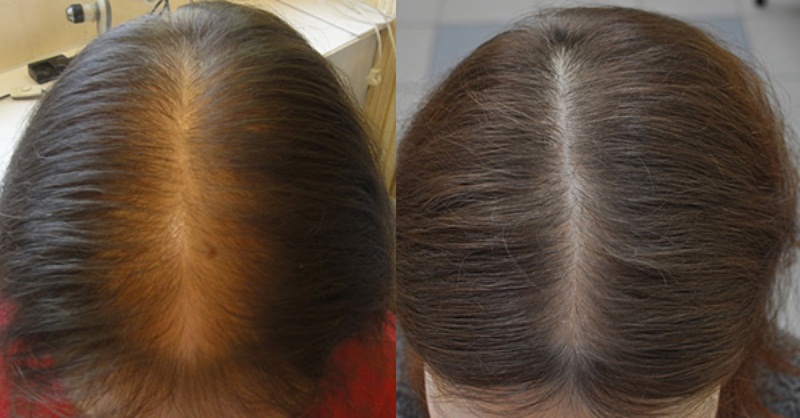 Фото до и после лечения выпадения волос
