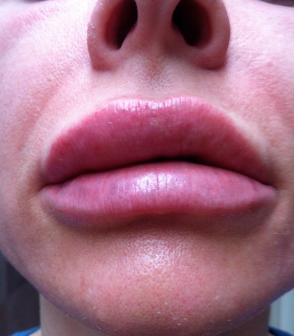 Чтобы избежать отеков и синяков нужно после увеличения губ придерживаться рекомендаций косметолога