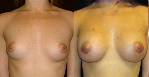 Фото до и после операции: коррекции подверглись обе железы, одна из которых была больше после грудного вскармливания