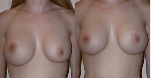 Фото до и после операции: у пациентки одна грудь после ГВ была больше, вторую увеличили до ее размера