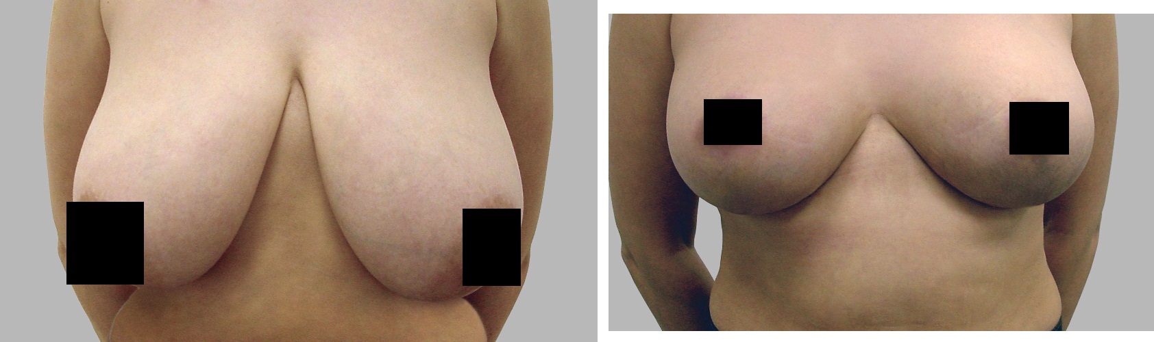 Фото до и после оперативного уменьшения груди
