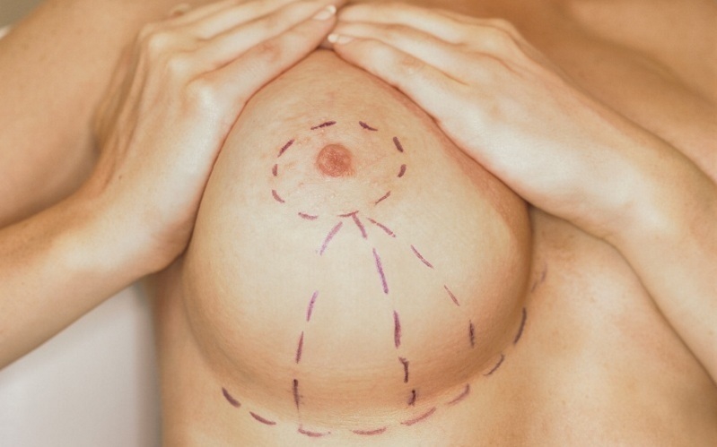 Уменьшение груди - разметка перед операцией