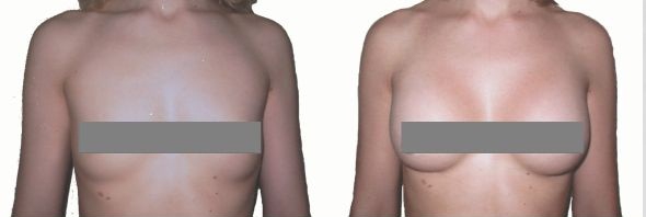 Фото до и после операционного увеличения груди