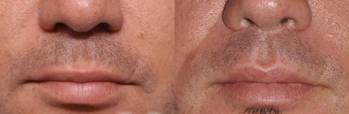 Увеличение губ: фото до и после операции