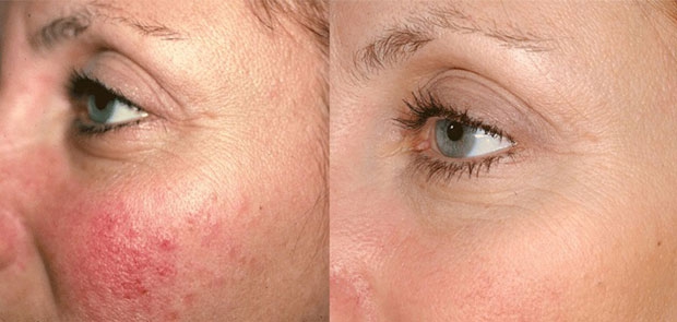 Лечение купероза: фото до и после