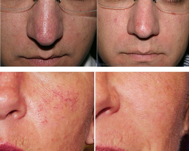 Лечение купероза: фото до и после лазеротерапии