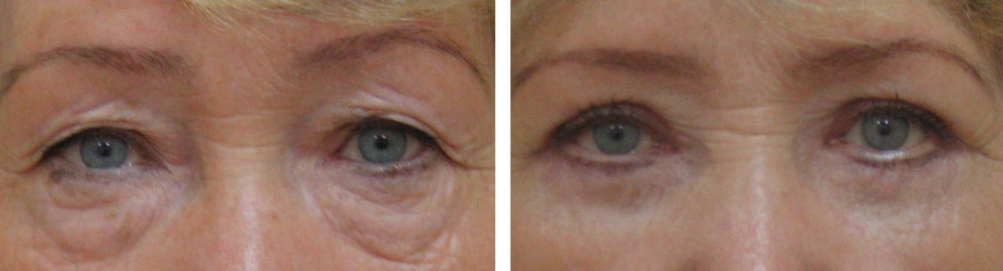 Фото пациентки до и после устранения мешков под глазами лазером