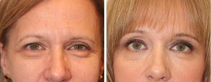 Фото пациентки до и после устранения мешков под глазами (мезотерапия)