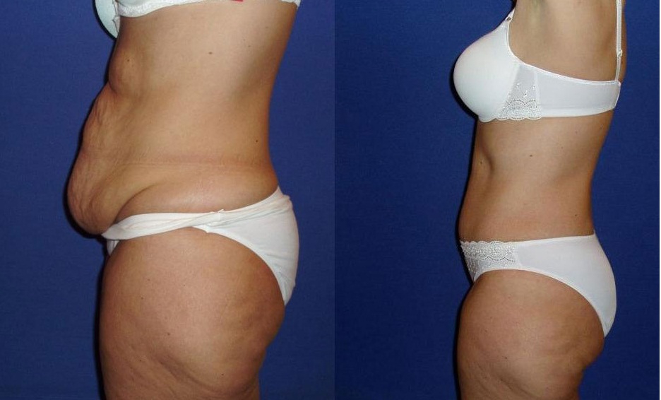 Ожирение у женщин. Абдминопластика: до и после операции