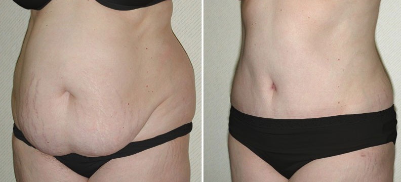 Хирургия последствий ожирения. Панникулэктомия: фото до и после операции