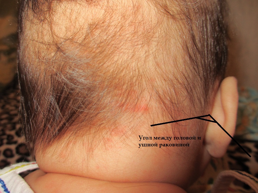 Главный симптом лопоухости у ребенка – это отхождение ушной раковины от головы на угол более 30 градусов