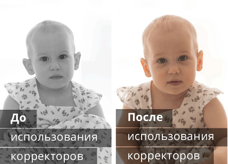 Лопоухость у малыша: фото до и после использования корректора