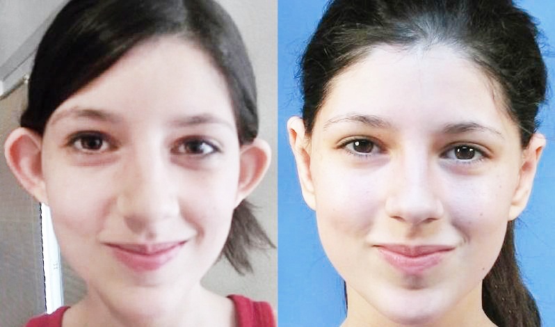 Фото ребенка до и после хирургического устранения лопоухости