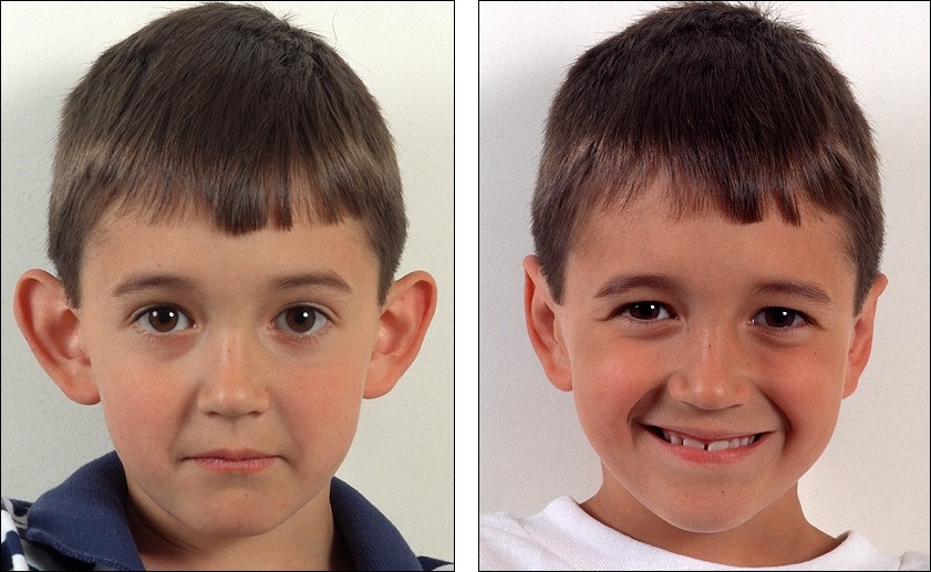 У ребенка торчат уши: фото до и после отопластики