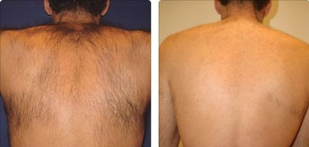Мужская эпиляция - удаление волос на спине