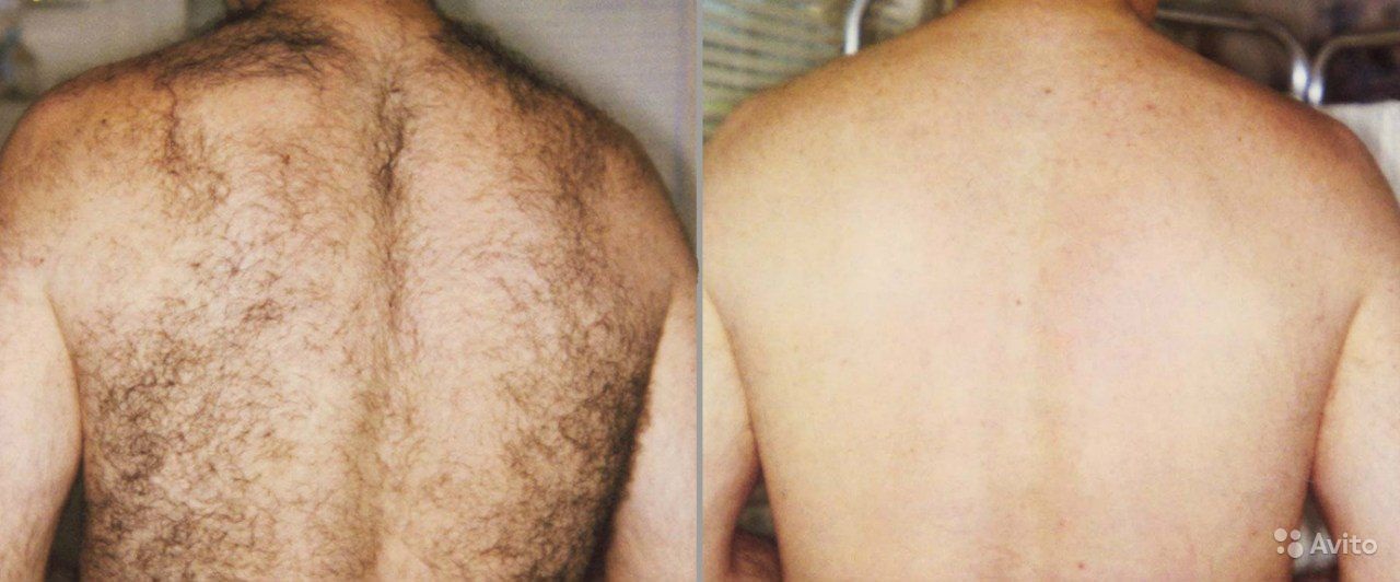 Мужская эпиляция - удаление волос на спине