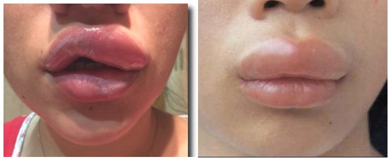 Отек губ может быть следствием аллергической реакции
