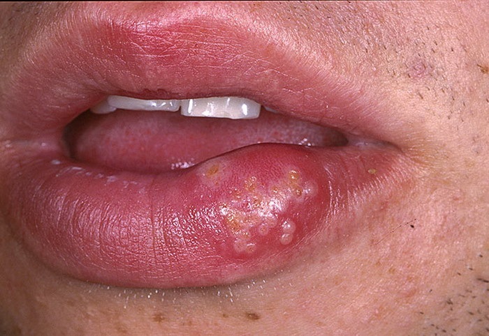 Сколько держится отек после увеличения губ, зависит от присоединения вторичной инфекции, в том числе герпеса