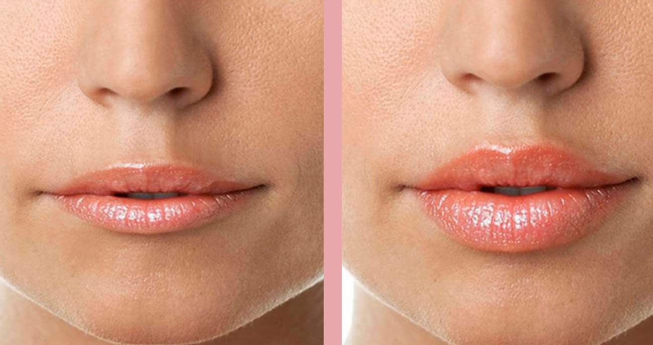 Фото до и после использования помпы для увеличения губ