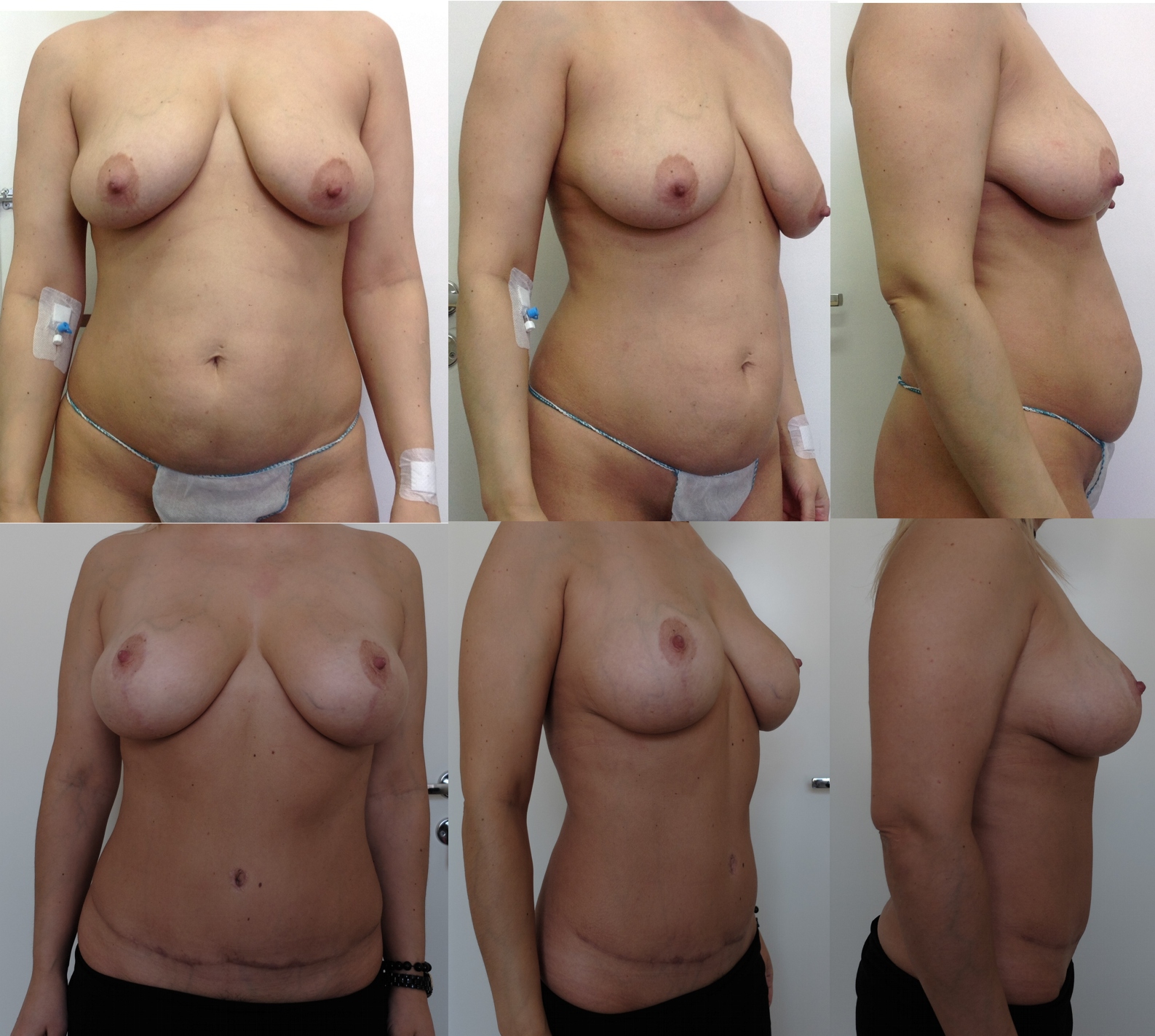 уменьшение объема груди у женщин фото 116