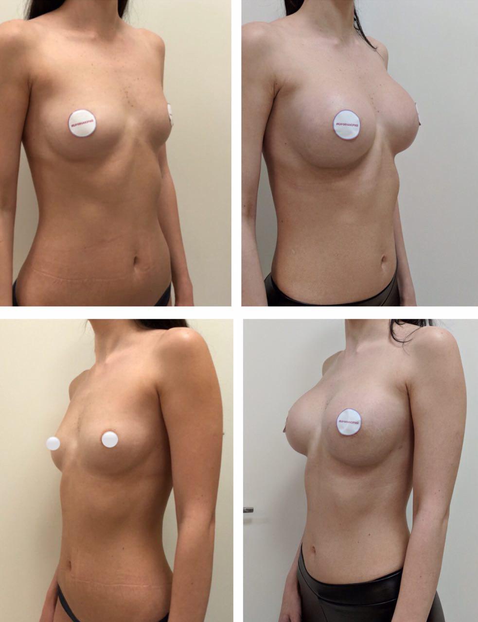 разные импланты на одну грудь фото 109