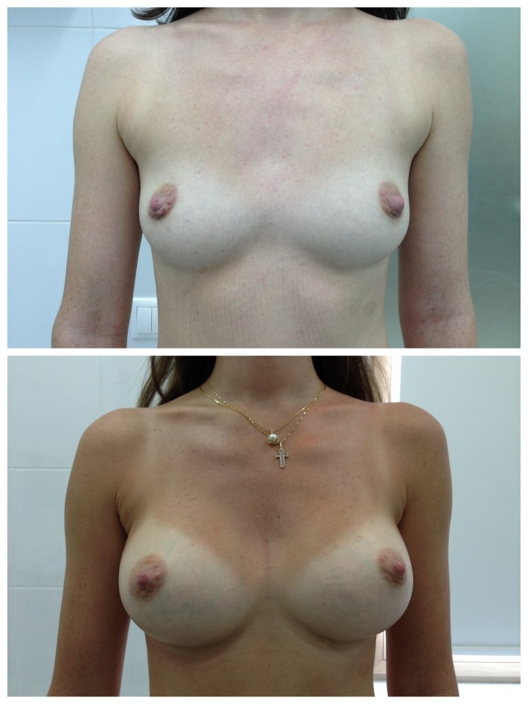 Фото до и после эндопротезирования груди - Мистакапуло Ф. Н,