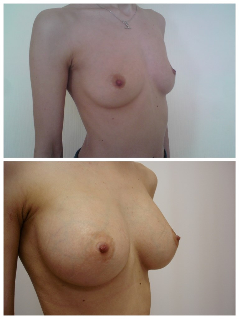 Фото до и после эндопротезирования груди - Мистакапуло Ф. Н,